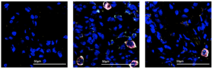 Cell populations active in the lung in the first few days of COVID-19 infection