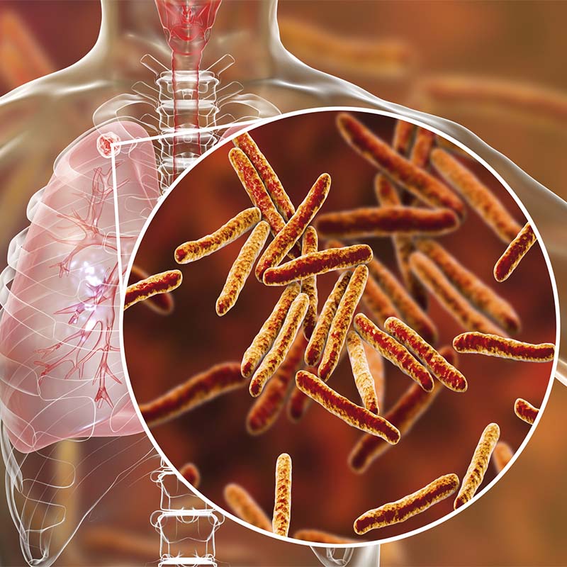 Tuberculosis Unit